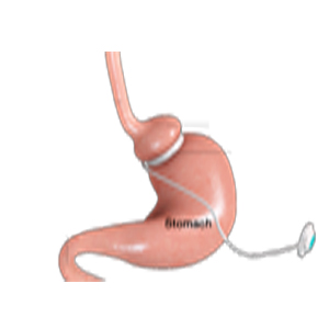 Gastric Band Adjustments